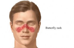 Lupus Malar Rash on Face
