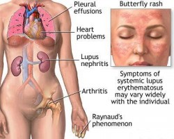 Lupus Symptoms in Women