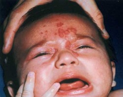 Neonatal Lupus Symptoms